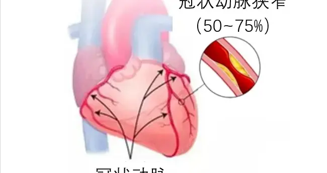 明明三高达标为何还“心梗”？只因 90% 的人犯了这个错！