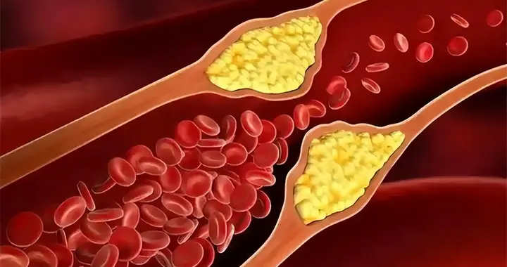 医生告诫：一旦吃上他汀药，5件事就不要做了，别拿身体开玩笑