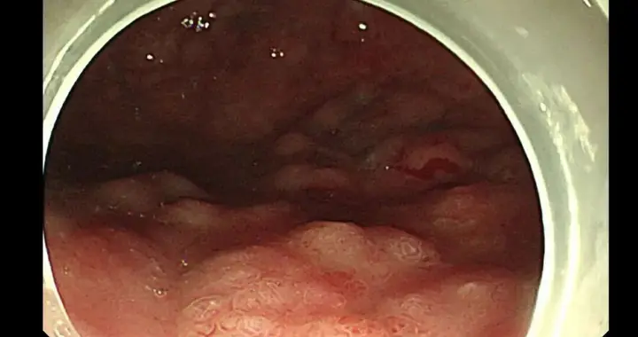 这次，幽门螺旋杆菌闯的祸有点大！