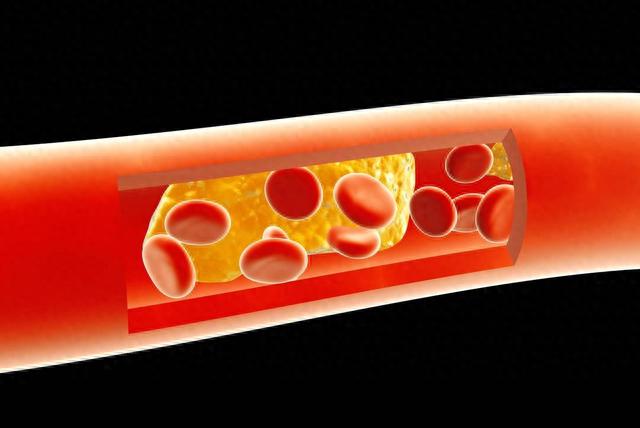 日本研究发现：血管变硬，与早饭有关？有科学依据吗？听医生分析