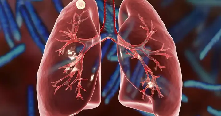 肺部CT报告，没有这4个词，肺癌风险很低!医生都在看这些!