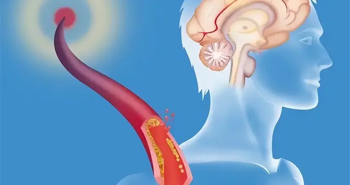 脑梗去世的人飙升！医生含泪苦劝：无论多大年纪，天冷坚守3原则