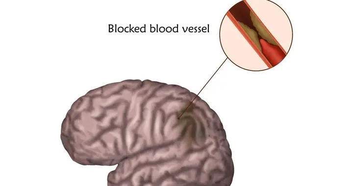 脑梗去世的人越来越多！这3条建议千万牢记！别等出事了后悔莫及