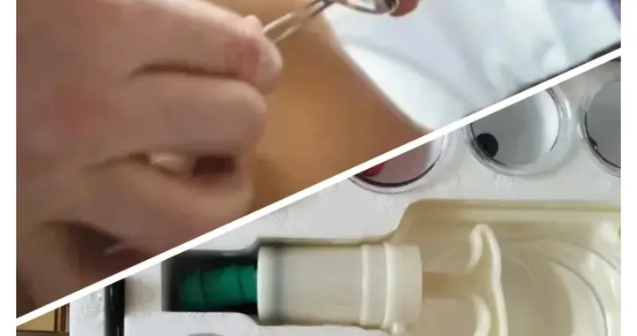 倪师针灸精要3.火罐的使用