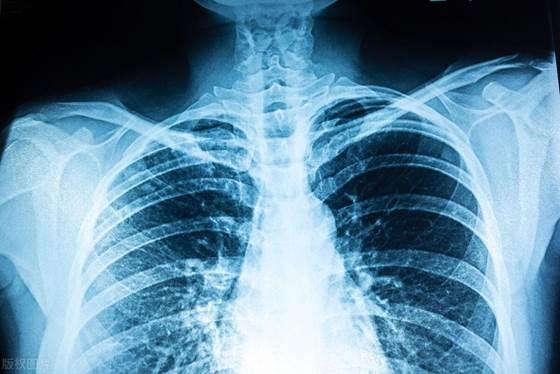 65岁大爷一年后血管斑块消失！养成4个习惯，斑块或可逐渐消散