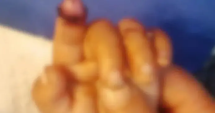 1岁娃喂兔子被咬断手指，开膛兔子未找到，笼角寻回断指再植成功