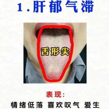 中医男科杜大夫：肝郁的 5 种舌象对照