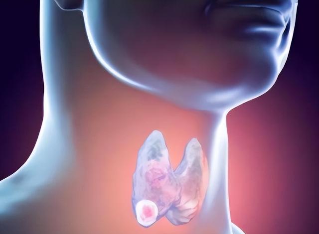 饮食|体内有“结节”的人，5种“发物”要少吃，忍住不吃或能赢