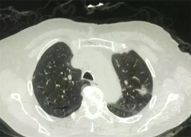 ?回顾：肺部CT报告单，“五个不用管，四个要重视”，早知有好处