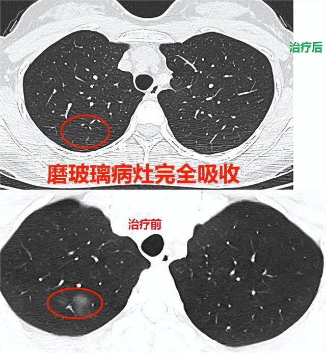 绿茶|辐射是肺CT检查永远避不开的问题！三个月复查是否影响身体健康？