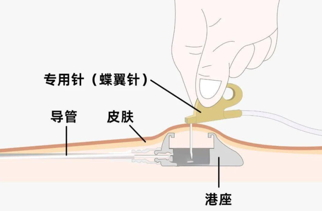 化疗选PICC还是输液港？谁更胜一筹？听听医生怎么说！