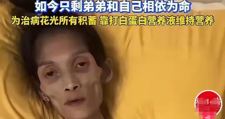 广东女孩巧巧去世，年仅27岁，减肥厌食症瘦到35斤，亲弟作秀被骂