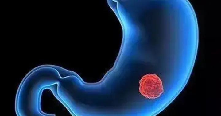 胃不舒服别总说老毛病？小心被胃癌盯上，高危人群建议做胃镜检查