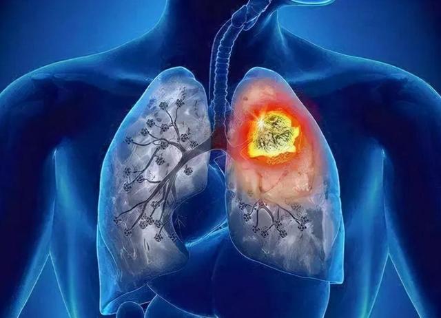 痰是肺的“信号器”？白痰、绿痰、黄痰、黑痰，分别代表什么呢？