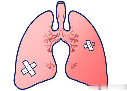 被严重低估的“散结救星”，化痰通阳，肺结节乖乖绕道