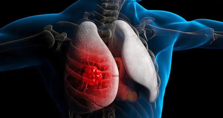 不抽烟为什么会患肺癌，大家观念要改改了，抽烟只是肺癌病因之一