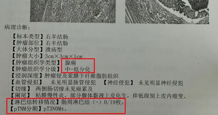 59岁结肠癌，术后腹膜转移、肝转移——病理报告解读