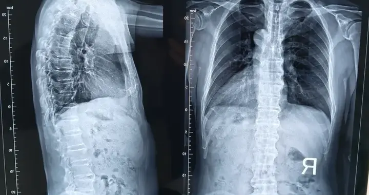 摸过上万根脊柱的老中医说：强直这病，最怕你“认命”