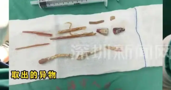 狠人，男子尿道藏大量异物长达20年