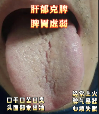 薛老师舌象分析：肝郁克脾 脾胃虚弱 肝郁脾虚 寒湿重