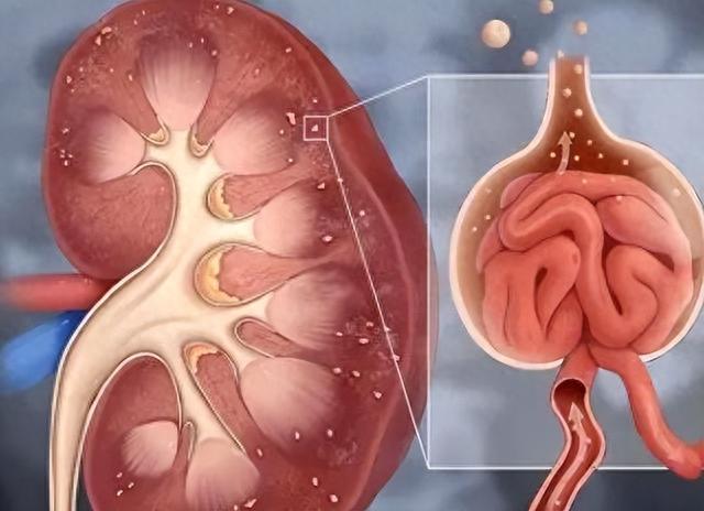 尿毒症是怎么来的？医生提醒：如有2处发臭，晚上尽量坚持4不要