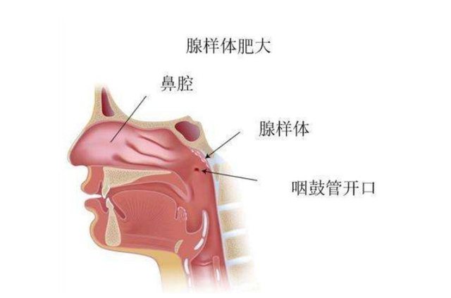 腺样体肥大的孩子，若反复感冒未根治，即使手术后会出问题吗？