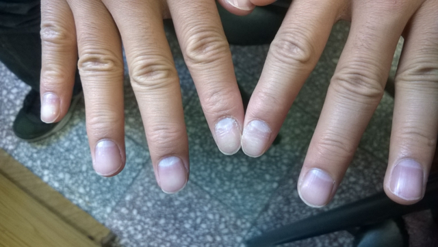 肾“衰”手先知，手上一旦出现这五种“丑象”，肾脏可能已被掏空