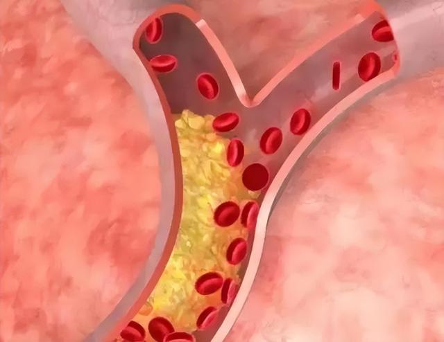血脂高的人，猪蹄、鸡蛋和牛奶，哪个能吃？别乱猜，医生说出实情