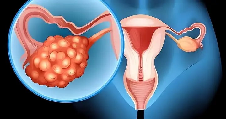 卵巢癌70%确诊已是晚期，正在盯上30+女性，出现7类信号别忽视