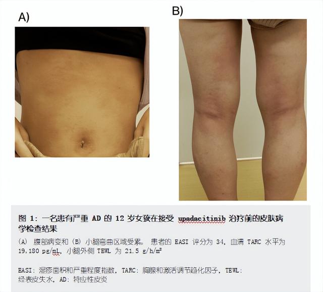 两名AD儿科患者在Upadacitinib治疗后改善Th2相关炎症标志物