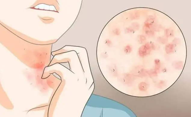 湿热过重，总是经常起疹子，瘙痒难受，一个中成药祛湿止痒！