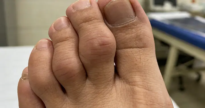 为什么很多人不愿手术？矫正器能矫正脚骨畸形吗？看穿这3个真相