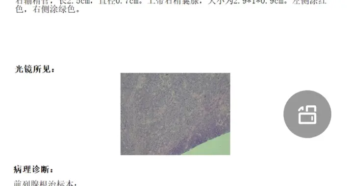 65岁前列腺癌，达芬奇机器人术后，切缘见癌累及——病理报告解读