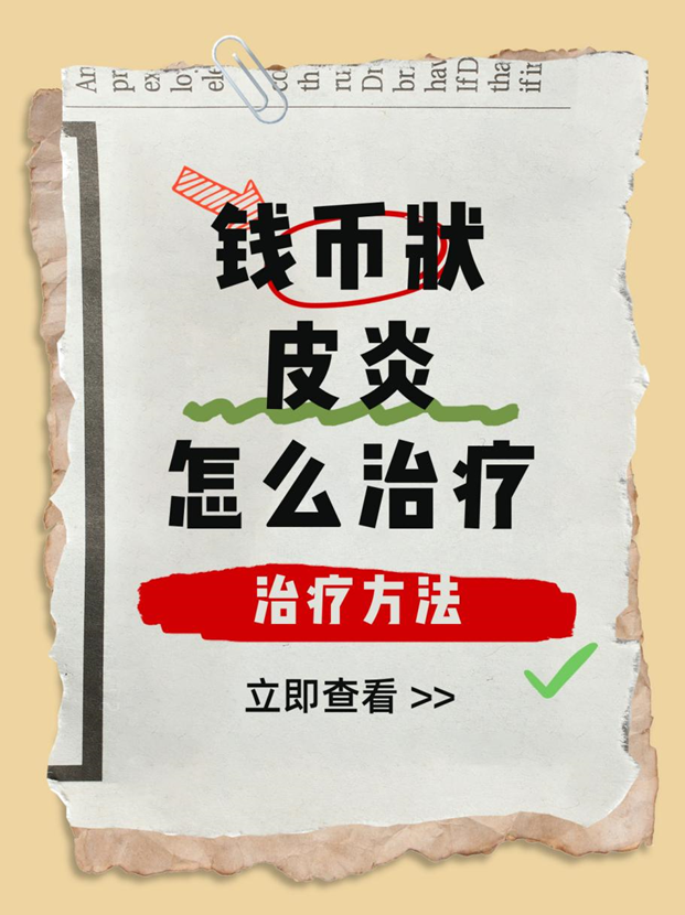 钱币状皮炎怎么治疗