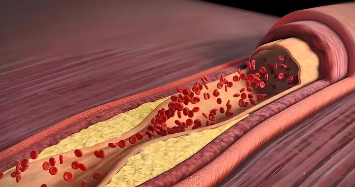 高血脂病人有三坎，熬过就长寿：三坎是指哪3事？55岁后得重视