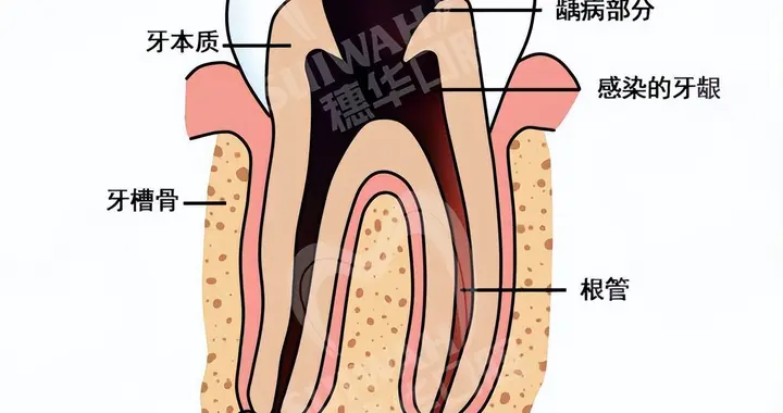 牙龈上鼓起的“小肉球”是什么？要处理吗？