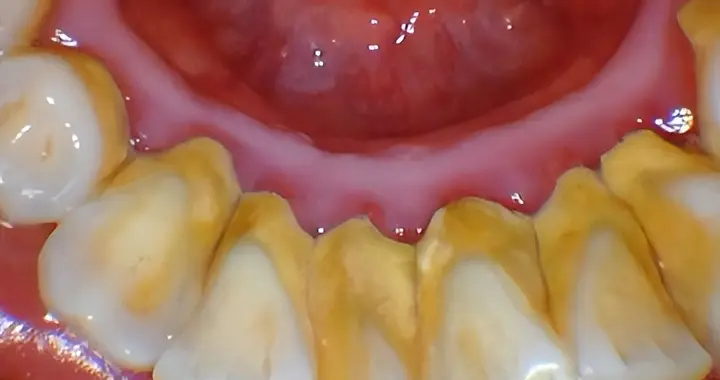 牙垢和牙石的区别