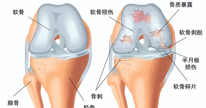 干细胞修复膝关节损伤，拒绝“人未老腿先衰”