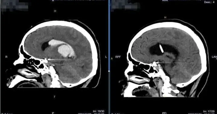 微创技术破难关，卧床时间缩最短！—肖庆主任带领团队守护脑健康