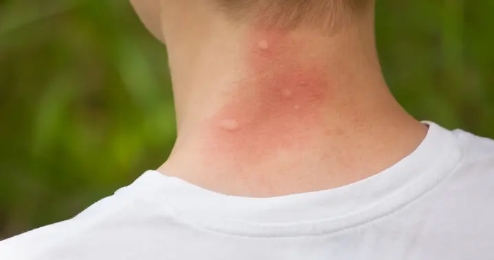 今年蚊子或将迎来“史诗级”加强？医生提醒：科学防蚊要趁春