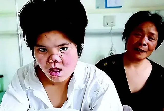 世界首例“坑面女孩”整容变少女，与兄长联姻，子女现已12岁