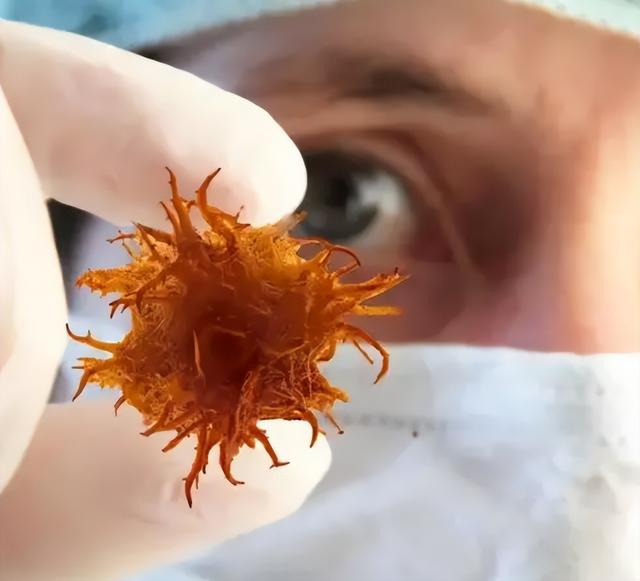 “癌”是西医叫法，中医盛行的古代“癌”叫啥？仅一个字却很耳熟