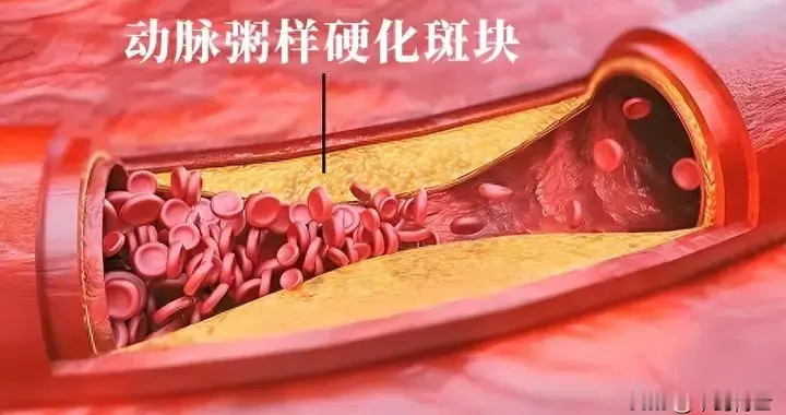 20多岁血管就长斑块？这些习惯正在加速动脉粥样硬化