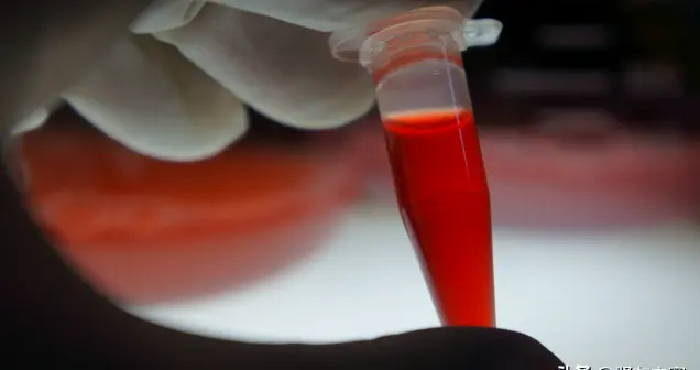 尿色发红就是血尿？不一定！肾友要分清这 2 种情况