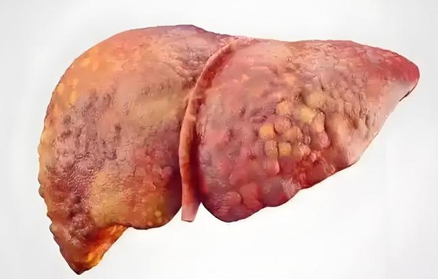 “查出肝硬化，我还能活多久？”别慌！做好这4点