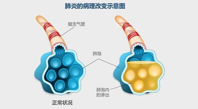 得了肺炎饮食上要注意什么？肺炎出现哪些症状表示好转？