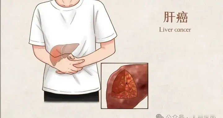 18周肿瘤清零，100%控制率：全球首款肝癌TIL疗法BST02闪耀国际！