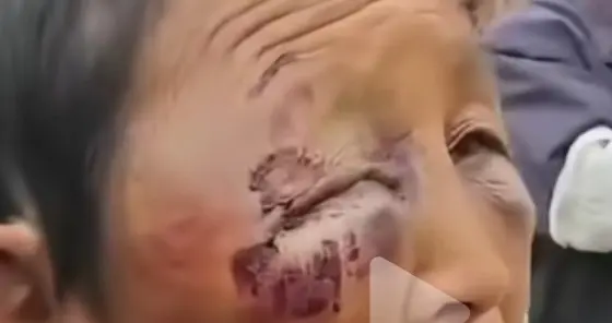 一妇女遭丈夫多次家暴住院，出院后继续被挨打，耳朵肿，妇联介入