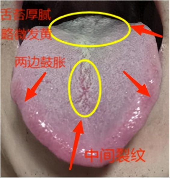 “见花谢、望门而泣”，吃桂附地黄丸、右归丸无效，原因就在舌头