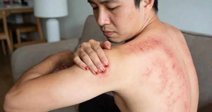 皮肤专家：长了这种“风团”，喉头水肿窒息几率飙升？别不信